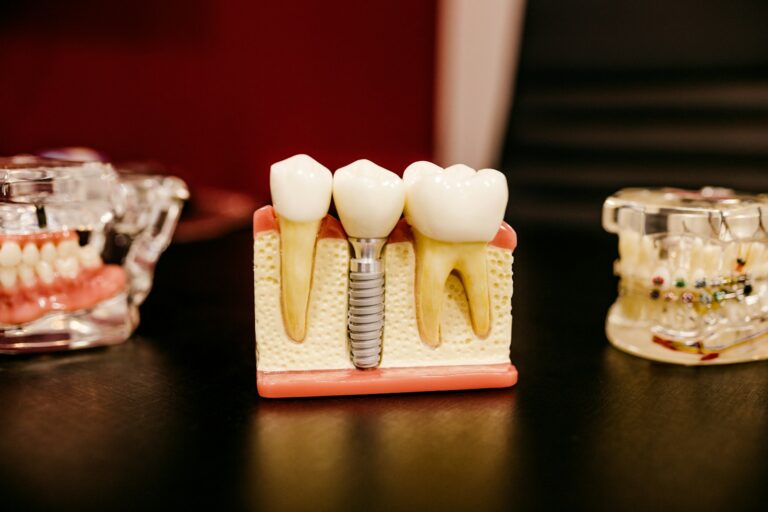 Are You Ready to Have Your Dental Implants in Liverpool?